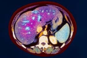 Fatty liver. Coloured computed tomography (CT) scan of an axial section through the abdomen of a 66 year old woman suffering from fatty liver. At lower centre is a bone of the vertebra (white). The liver is the large organ occupying much of the abdomen at upper left to right (purple). Fatty deposits in the liver show up as blue patches. The liver cells become swollen by large fat droplets. This condition occurs in heavy drinkers and alcoholics, where high levels of alcohol in the blood disturbs normal fat metabolism. Fatty deposits in the liver can also be caused by hypoxia, toxins or diabetes mellitus.